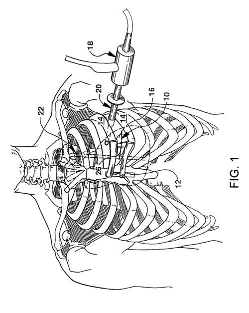 coronary artery om branch,Coronary Artery Om Branch: A Comprehensive Overview